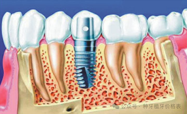 种植牙集中采购_种牙集中采购_种植牙集采价格